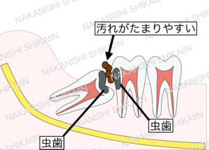 親知らずと手前の歯の間に汚れがたまり、虫歯になりやすい