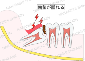 親知らずと手前の歯の間に汚れがたまり、歯茎が腫れる