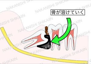 親知らずと手前の歯の間に汚れがたまり、骨が溶けていく