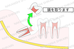 親知らずの抜歯について。分割し、頭の部分を先に取り出します