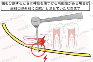 親知らずの抜歯について。歯を分割するときに神経を傷つける可能性がある場合は歯科口腔外科病院に紹介とさせていただきます
