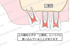 親知らずの抜歯について。親知らずが上顎洞という穴に食い込んでいる時があります