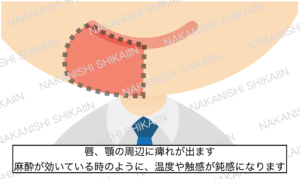 顎の神経が痺れると、唇や顎の周辺が痺れます。麻酔が効いているように温度や触感が鈍感になります
