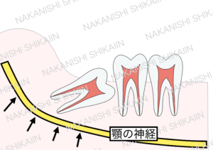 親知らずの抜歯について。親知らずの近くには顎の神経（下槽管）があります