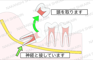 親知らずの抜歯について。親知らずを分割し、頭の部分を取り出します