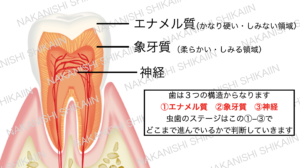 歯は「エナメル質」「象牙質」「神経」と３構造あり、どこまで虫歯が進んでいるかでステージが変わります