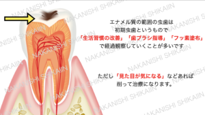 エナメル質の虫歯は初期虫歯と言われ、生活習慣や歯ブラシ、フッ素塗布で経過観察していきます。見た目が気になるとなれば削って治療です