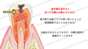 象牙質に達すると治療になります。