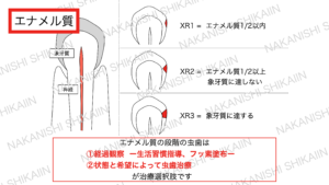 エナメル質は経過観察か、希望によっては治療となります。