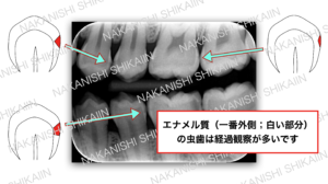 エナメル質の虫歯は経過観察が多いです
