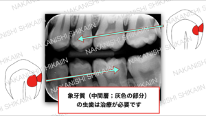 象牙質の虫歯は治療が必要になります。