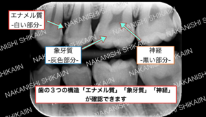 白い部分がエナメル質、灰色の部分が象牙質、黒い部分は神経です