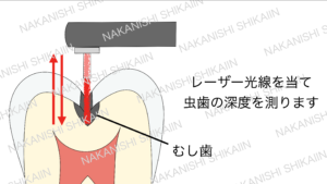 ダイアグノデントペンはレーザー光線で虫歯の深さを測ります