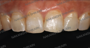 審美セラミックス治療の被せ物