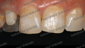 審美セラミックスの被せ物は左側の歯です。見た目では分からないです