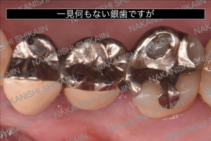 一見何もなさそうな銀歯ですが