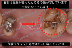 銀歯を外すと中が虫歯になっています