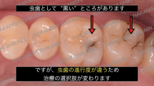 歯に黒い点の初期虫歯と治療すべき虫歯がある状態