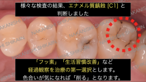 黒いが初期虫歯であればフッ素塗布などで予防していく