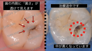 削ってみると中が虫歯になっている