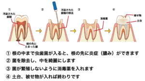 根の治療（根管治療）の流れ
