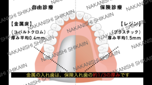 保険と金属の入れ歯の違い（総義歯）