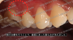 根の治療（根管治療）で膿みが治った状態