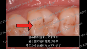 詰め物の下が虫歯になっている