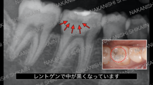 詰め物の下が黒く虫歯になっているレントゲン