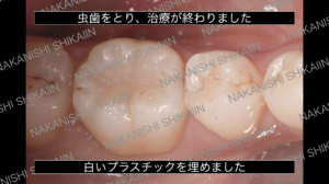 詰め物、ダイレクトボンディングをした状態