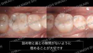 虫歯を治して詰め物をした状態