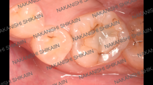 詰め物が虫歯になっている