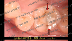 詰め物が虫歯になっている場所について