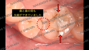 歯と歯の間も虫歯になっていた状態