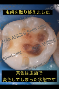 虫歯を取り終わった時の状態と変色状態