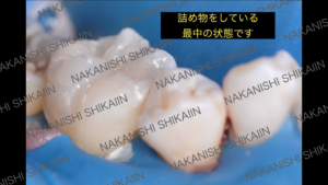 詰め物、ダイレクトボンディングをしている時
