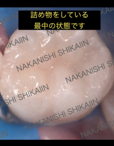 詰め物、ダイレクトボンディングをしている時の写真