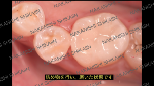 詰め物、ダイレクトボンディングが終わった状態