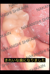 詰め物、ダイレクトボンディング治療後の状態