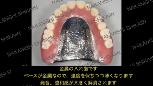 金属の入れ歯（総義歯、金属床）