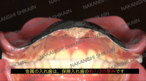 金属の入れ歯の薄さについて