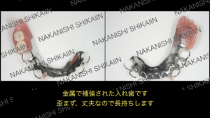 金属の入れ歯