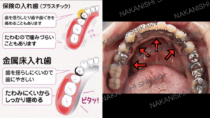 保険と金属の入れ歯の違い