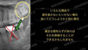 親知らずがあれば移植できるかもしれない