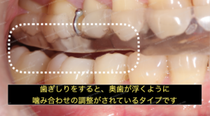歯ぎしりをすると、奥歯が浮くように噛み合わせが調整されているタイプです