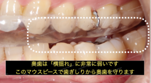 歯ぎしりをすると、奥歯が浮くように噛み合わせが調整されているタイプです。奥歯は横揺れに弱いので、マウスピースで歯ぎしりから守ります。