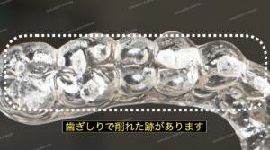 歯ぎしりでマウスピースが削れています２