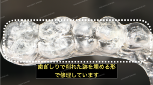 歯ぎしりで削れたマウスピースを修理しています１