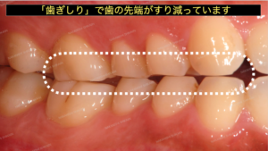 歯ぎしりで歯がすり減っています