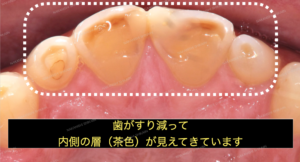 歯ぎしりで歯がすり減って茶色の部分が見えてきます